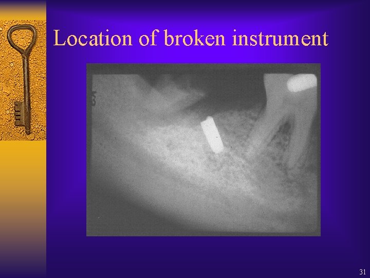 Location of broken instrument 31 Location of broken instrument 31