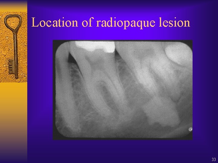 Location of radiopaque lesion 33 Location of radiopaque lesion 33