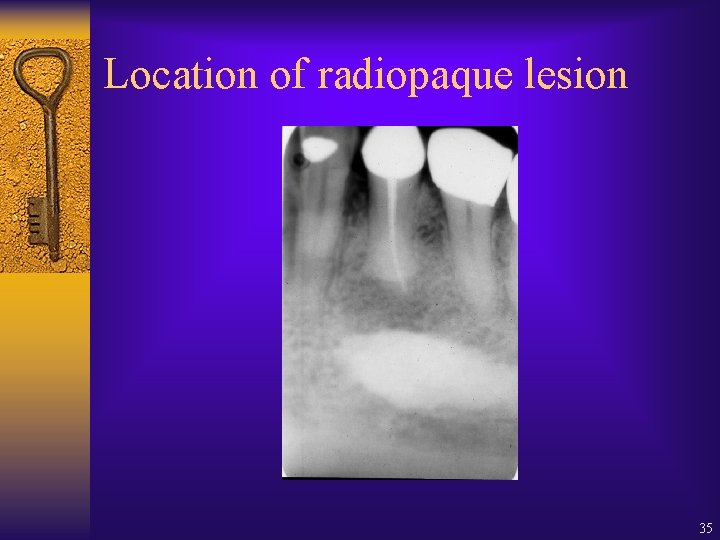Location of radiopaque lesion 35 Location of radiopaque lesion 35