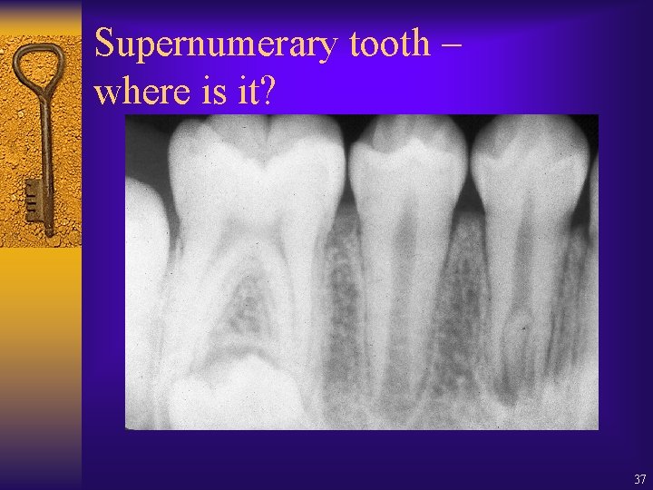 Supernumerary tooth – where is it? 37 Supernumerary tooth – where is it? 37