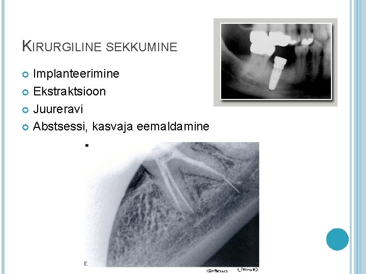 KIRURGILINE SEKKUMINE Implanteerimine Ekstraktsioon Juureravi Abstsessi, kasvaja eemaldamine KIRURGILINE SEKKUMINE Implanteerimine Ekstraktsioon Juureravi Abstsessi, kasvaja eemaldamine