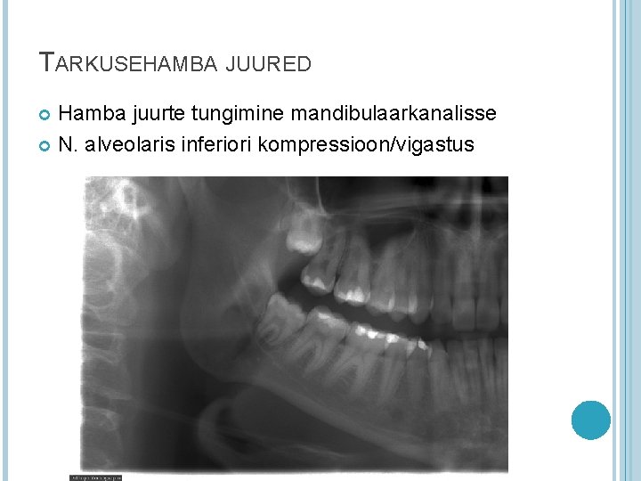 TARKUSEHAMBA JUURED Hamba juurte tungimine mandibulaarkanalisse N. alveolaris inferiori kompressioon/vigastus TARKUSEHAMBA JUURED Hamba juurte tungimine mandibulaarkanalisse N. alveolaris inferiori kompressioon/vigastus