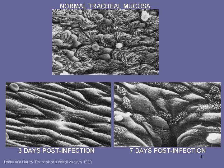 NORMAL TRACHEAL MUCOSA 3 DAYS POST-INFECTION 7 DAYS POST-INFECTION 11 Lycke and Norrby Textbook