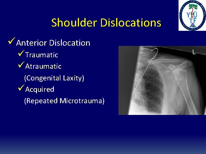 Shoulder Dislocations üAnterior Dislocation üTraumatic üAtraumatic (Congenital Laxity) üAcquired (Repeated Microtrauma) 