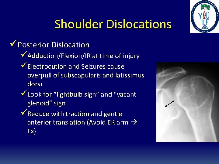 Shoulder Dislocations üPosterior Dislocation üAdduction/Flexion/IR at time of injury üElectrocution and Seizures cause overpull