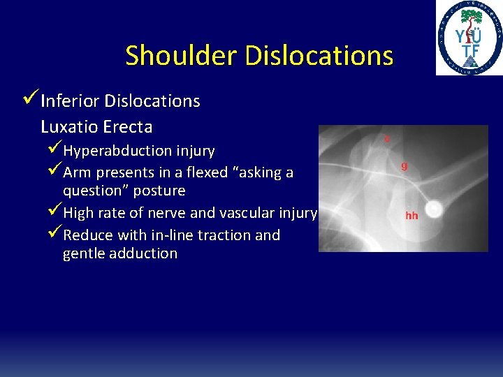 Shoulder Dislocations üInferior Dislocations Luxatio Erecta üHyperabduction injury üArm presents in a flexed “asking