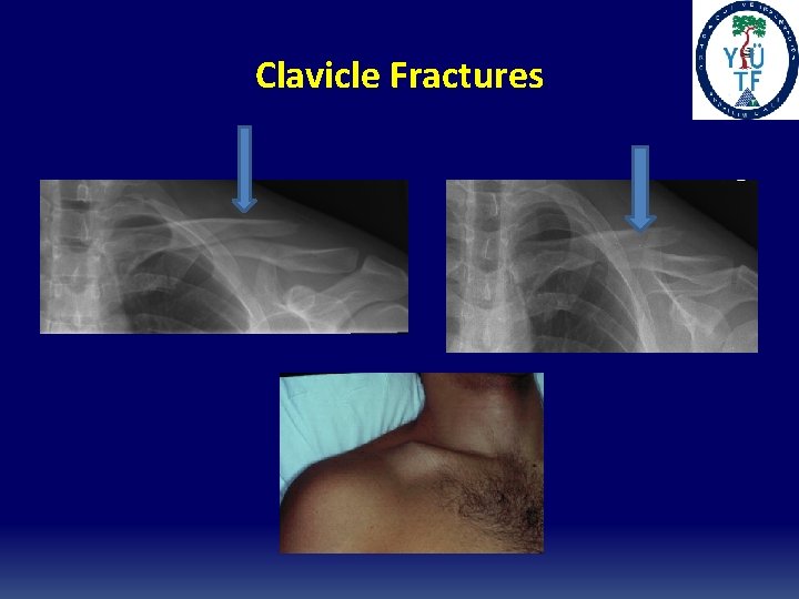 Clavicle Fractures 