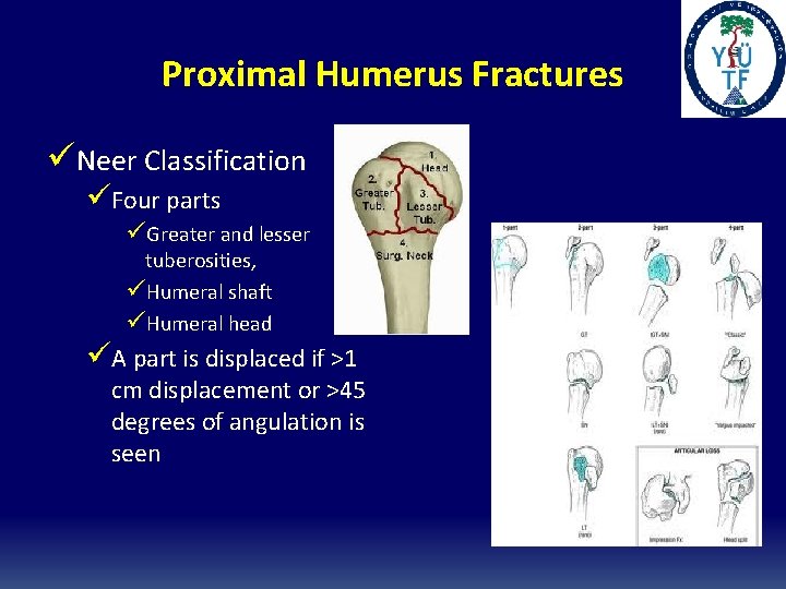 Proximal Humerus Fractures üNeer Classification üFour parts üGreater and lesser tuberosities, üHumeral shaft üHumeral