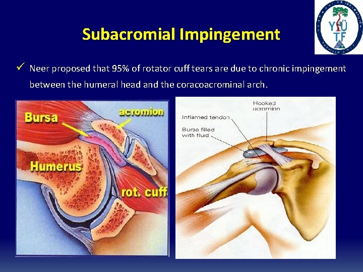 Subacromial Impingement ü Neer proposed that 95% of rotator cuff tears are due to