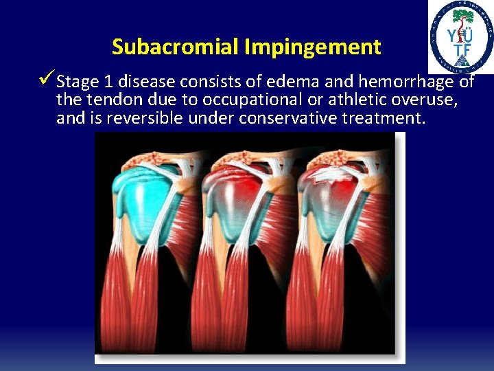 Subacromial Impingement üStage 1 disease consists of edema and hemorrhage of the tendon due