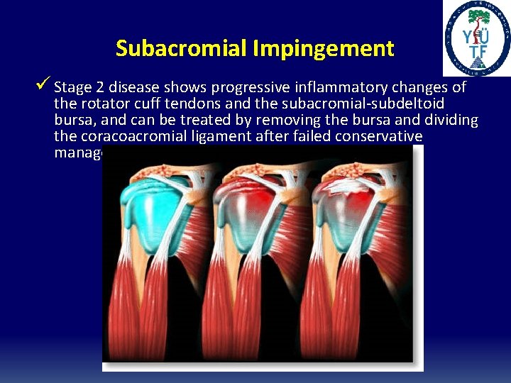 Subacromial Impingement ü Stage 2 disease shows progressive inflammatory changes of the rotator cuff
