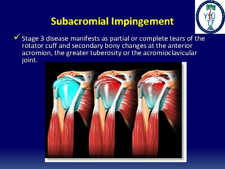 Subacromial Impingement ü Stage 3 disease manifests as partial or complete tears of the