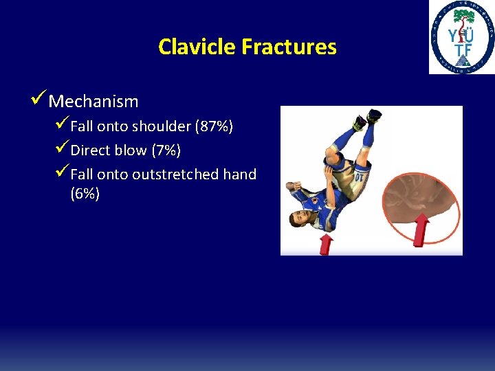 Clavicle Fractures üMechanism üFall onto shoulder (87%) üDirect blow (7%) üFall onto outstretched hand