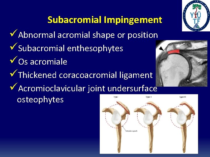 Subacromial Impingement üAbnormal acromial shape or position üSubacromial enthesophytes üOs acromiale üThickened coracoacromial ligament