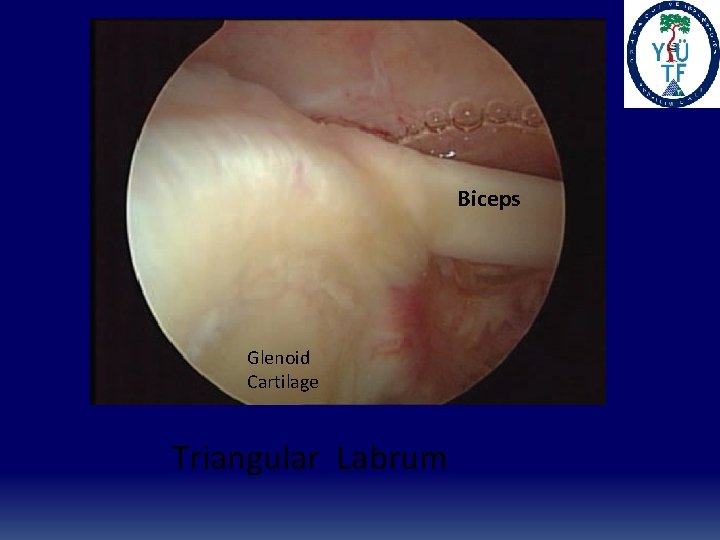 Biceps Glenoid Cartilage Triangular Labrum 