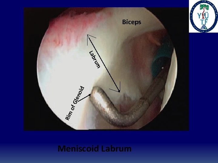 Biceps Rim of G len oid rum Lab Meniscoid Labrum 