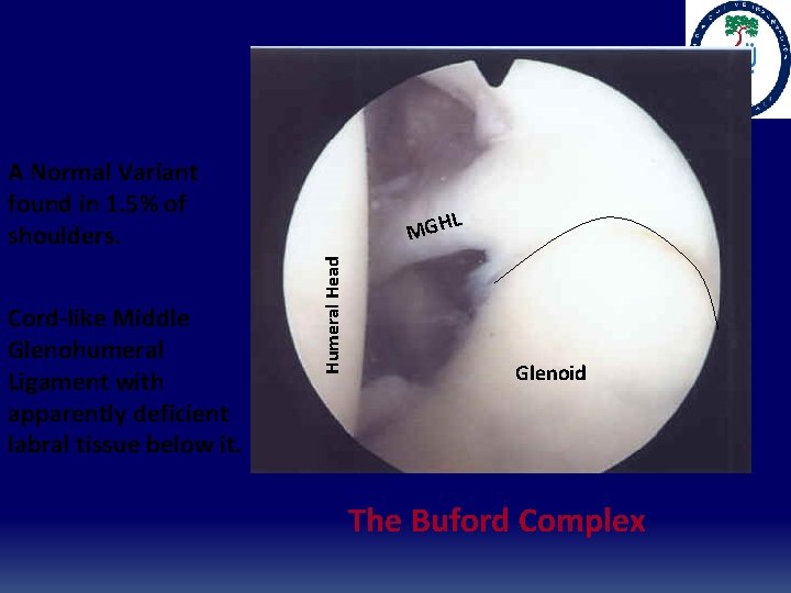 A Normal Variant found in 1. 5% of shoulders. Humeral Head Cord-like Middle Glenohumeral