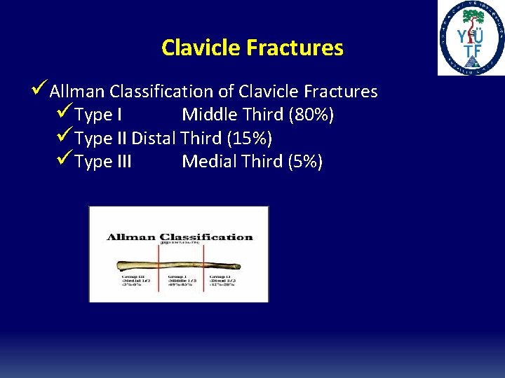 Clavicle Fractures üAllman Classification of Clavicle Fractures üType I Middle Third (80%) üType II