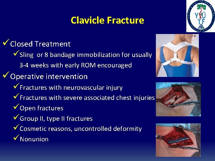 Clavicle Fracture üClosed Treatment üSling or 8 bandage immobilization for usually 3 -4 weeks