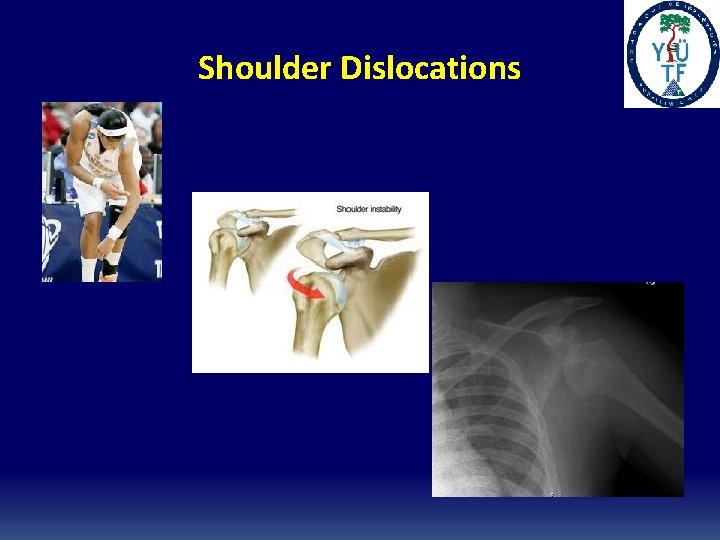 Shoulder Dislocations 