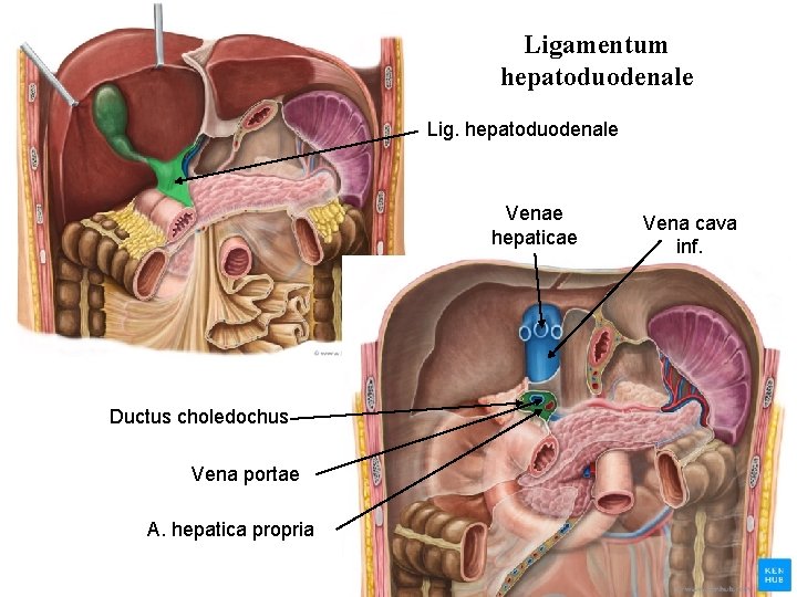 Ligamentum hepatoduodenale Lig. hepatoduodenale Venae hepaticae Ductus choledochus Vena portae A. hepatica propria Vena