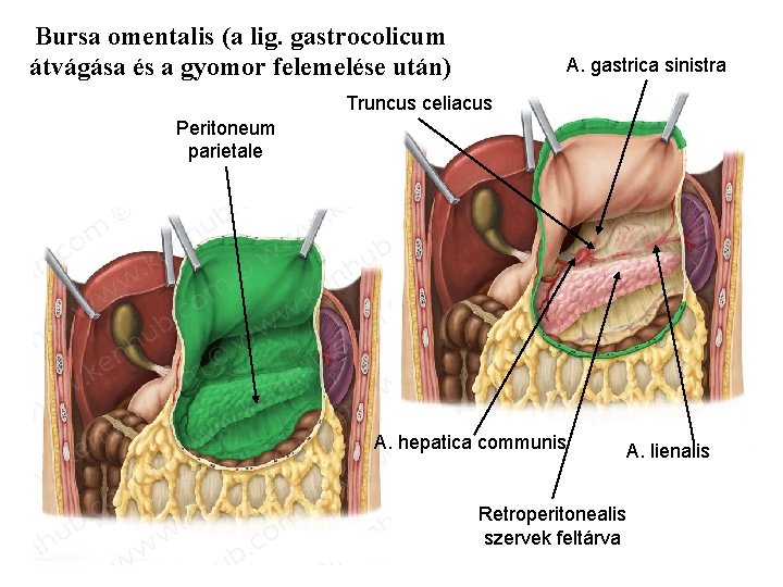 Bursa omentalis (a lig. gastrocolicum átvágása és a gyomor felemelése után) A. gastrica sinistra
