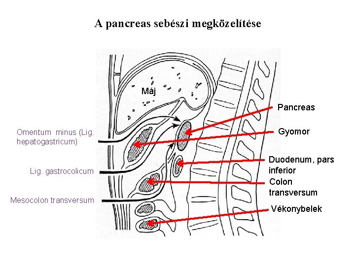 A pancreas sebészi megközelítése Máj Pancreas Omentum minus (Lig. hepatogastricum) Lig. gastrocolicum Mesocolon transversum