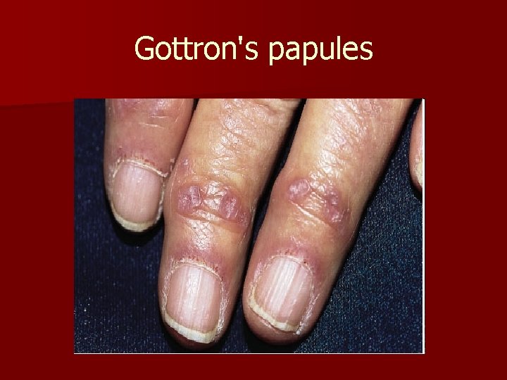 Gottron's papules 