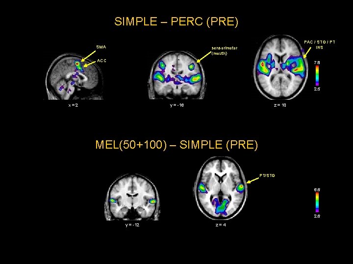 SIMPLE – PERC (PRE) SMA PAC / STG / PT INS sensorimotor (mouth) ACC