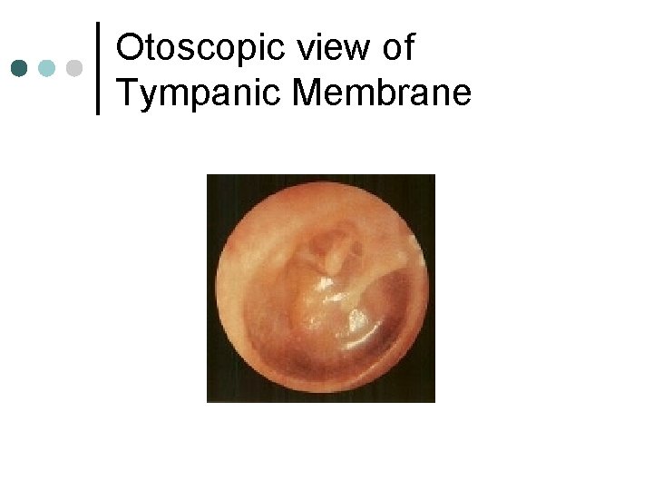 Otoscopic view of Tympanic Membrane 