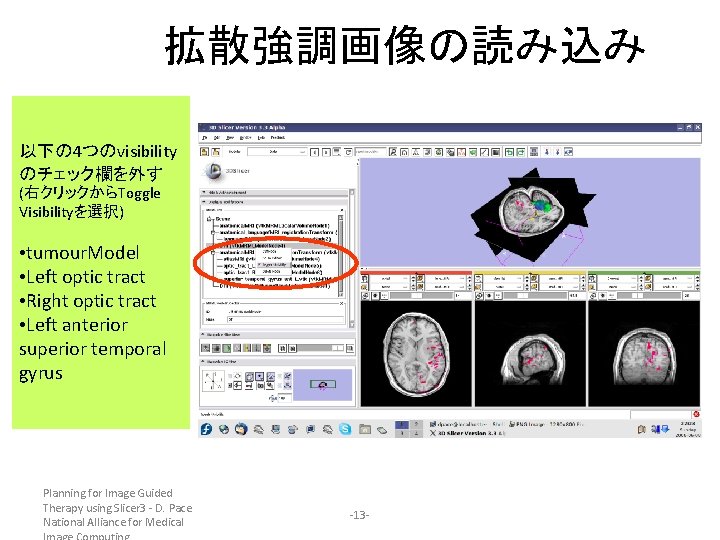 拡散強調画像の読み込み 以下の 4つのvisibility のチェック欄を外す (右クリックからToggle Visibilityを選択) • tumour. Model • Left optic tract •