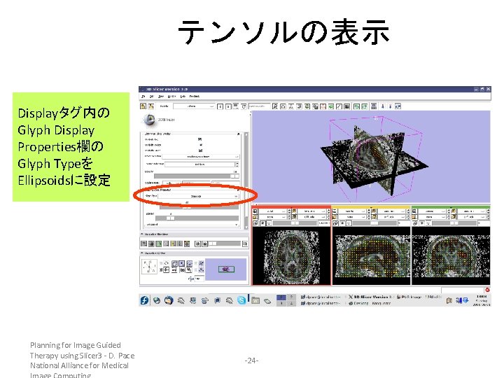 テンソルの表示 Displayタグ内の Glyph Display Properties欄の Glyph Typeを Ellipsoidsに設定 Planning for Image Guided Therapy using