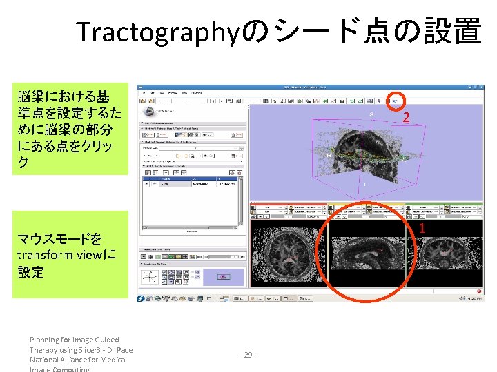 Tractographyのシード点の設置 脳梁における基 準点を設定するた めに脳梁の部分 にある点をクリッ ク 2 1 マウスモードを transform viewに 設定 Planning for