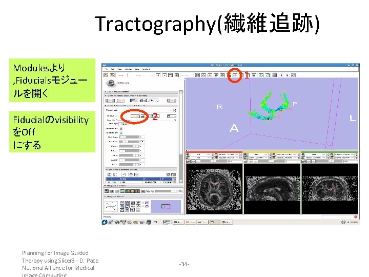 Tractography(繊維追跡) Modulesより , Fiducialsモジュー ルを開く Fiducialのvisibility をOff にする Planning for Image Guided Therapy using