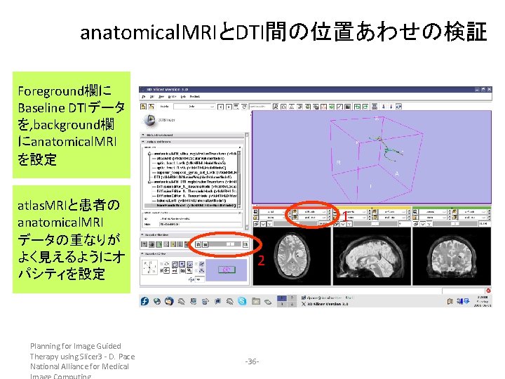 anatomical. MRIとDTI間の位置あわせの検証 Foreground欄に Baseline DTIデータ を, background欄 にanatomical. MRI を設定 atlas. MRIと患者の anatomical. MRI