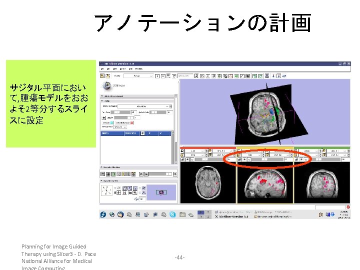 アノテーションの計画 サジタル平面におい て, 腫瘍モデルをおお よそ 2等分するスライ スに設定 Planning for Image Guided Therapy using Slicer