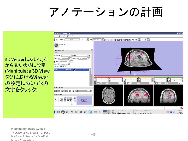 アノテーションの計画 3 D Viewerにおいて, 右 から見た状態に設定 (Manipulate 3 D View タグにおけるViewer の設定においてRの 文字をクリック) Planning