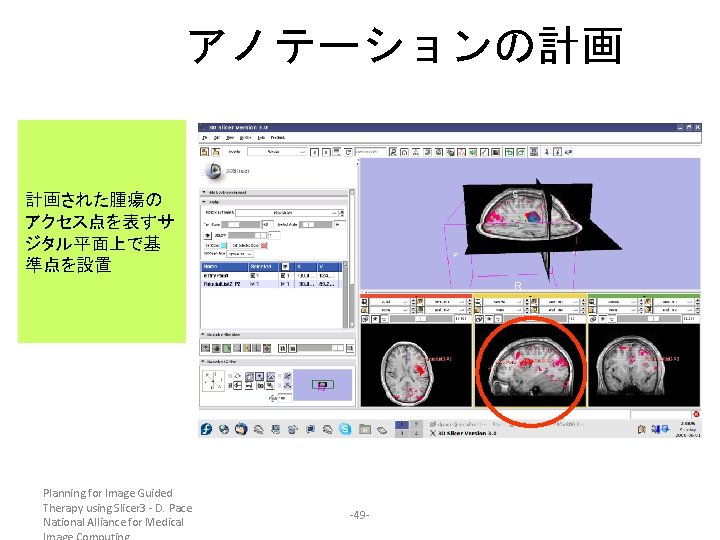アノテーションの計画 計画された腫瘍の アクセス点を表すサ ジタル平面上で基 準点を設置 Planning for Image Guided Therapy using Slicer 3 -