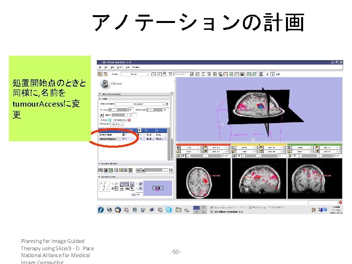 アノテーションの計画 処置開始点のときと 同様に, 名前を tumour. Accessに変 更 Planning for Image Guided Therapy using Slicer