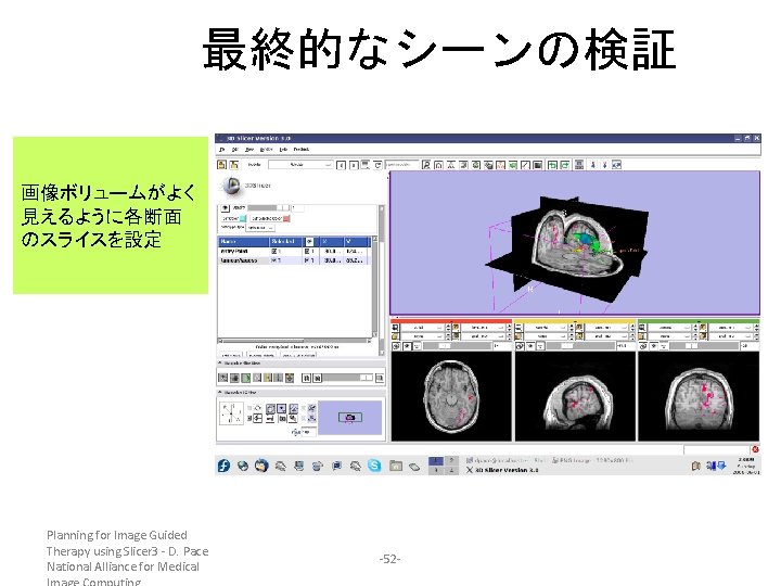 最終的なシーンの検証 画像ボリュームがよく 見えるように各断面 のスライスを設定 Planning for Image Guided Therapy using Slicer 3 - D.