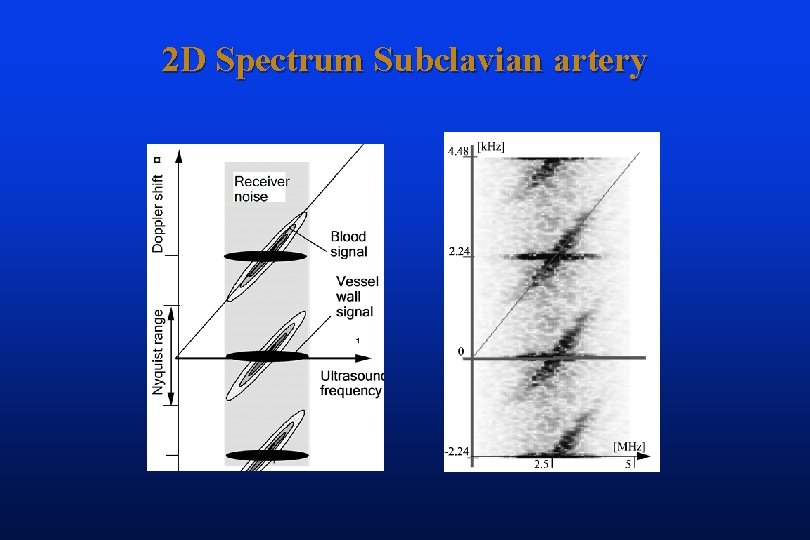 2 D Spectrum Subclavian artery 
