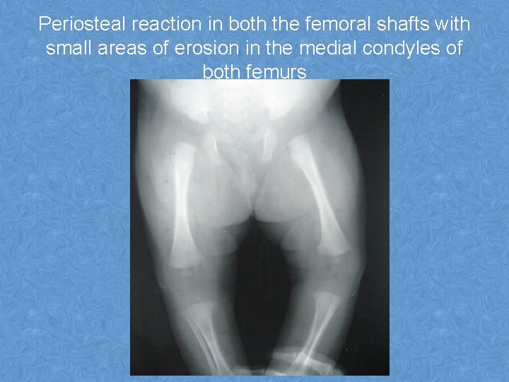 Periosteal reaction in both the femoral shafts with small areas of erosion in the