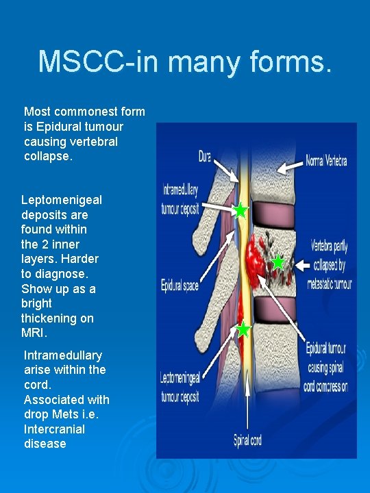 MSCC-in many forms. Most commonest form is Epidural tumour causing vertebral collapse. Leptomenigeal deposits