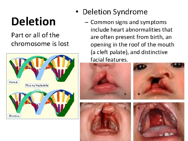 Deletion Part or all of the chromosome is lost • Deletion Syndrome – Common