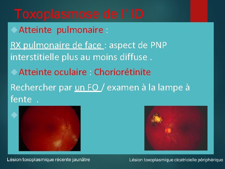 Toxoplasmose de l’ ID Atteinte pulmonaire : RX pulmonaire de face : aspect de