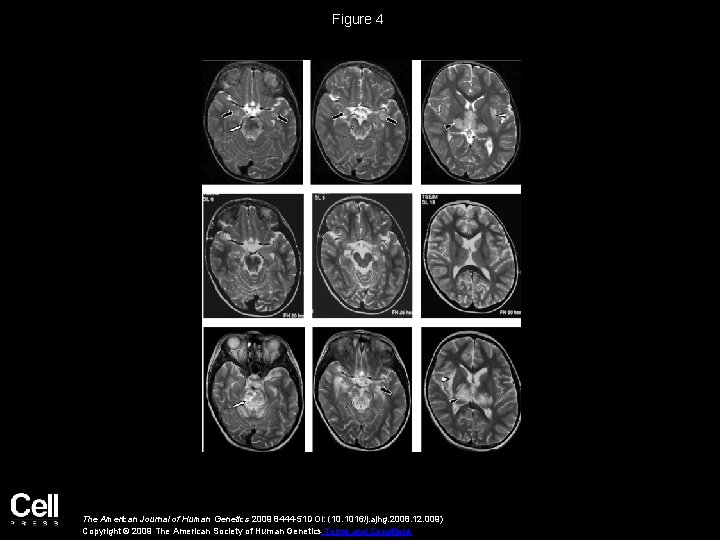 Figure 4 The American Journal of Human Genetics 2009 8444 -51 DOI: (10. 1016/j.