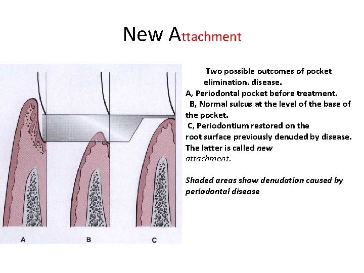 New Attachment Two possible outcomes of pocket elimination. disease. A, Periodontal pocket before treatment.