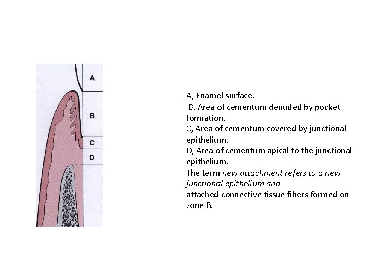 A, Enamel surface. B, Area of cementum denuded by pocket formation. C, Area of