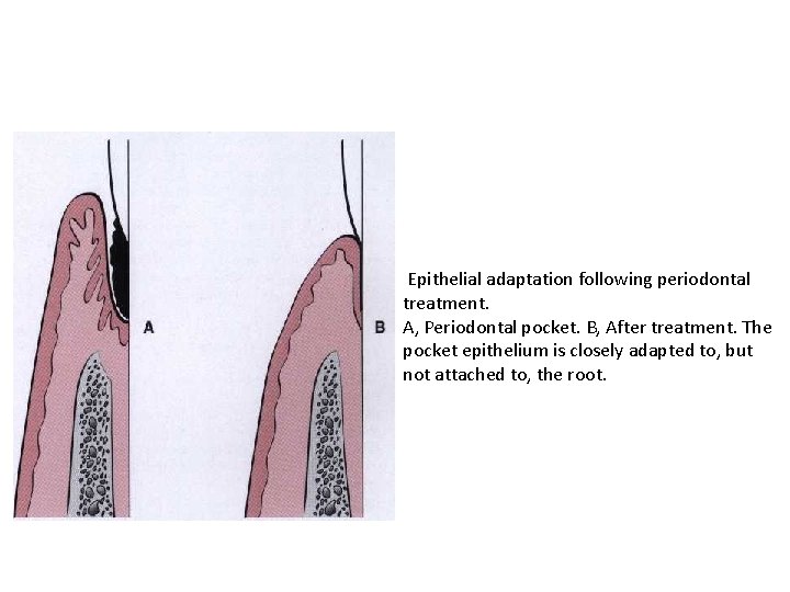 Epithelial adaptation following periodontal treatment. A, Periodontal pocket. B, After treatment. The pocket epithelium