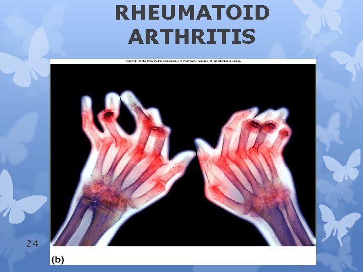 RHEUMATOID ARTHRITIS 24 